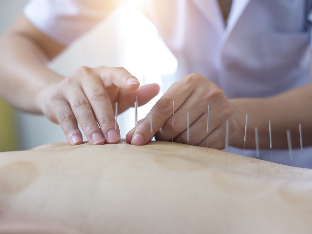 Acupuncture Services In Santa Monica